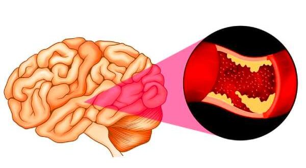 اعراض الجلطة الدماغية التي يجب الانتباه لها
