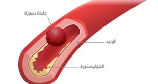 اعراض الجلطة .. احذر من هذه العلامات!