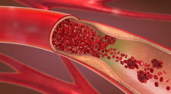 تنظيف الشرايين والاوعية الدموية بالطرق الطبيعية