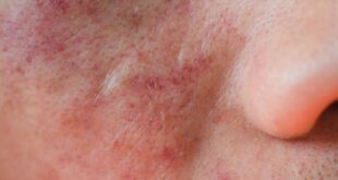 اكزيما الوجه: أهم الأعراض والعلاجات وطرق العناية